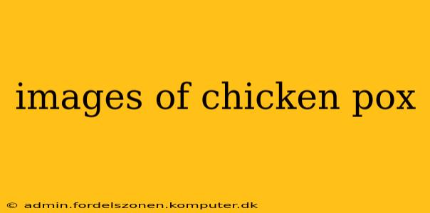 images of chicken pox